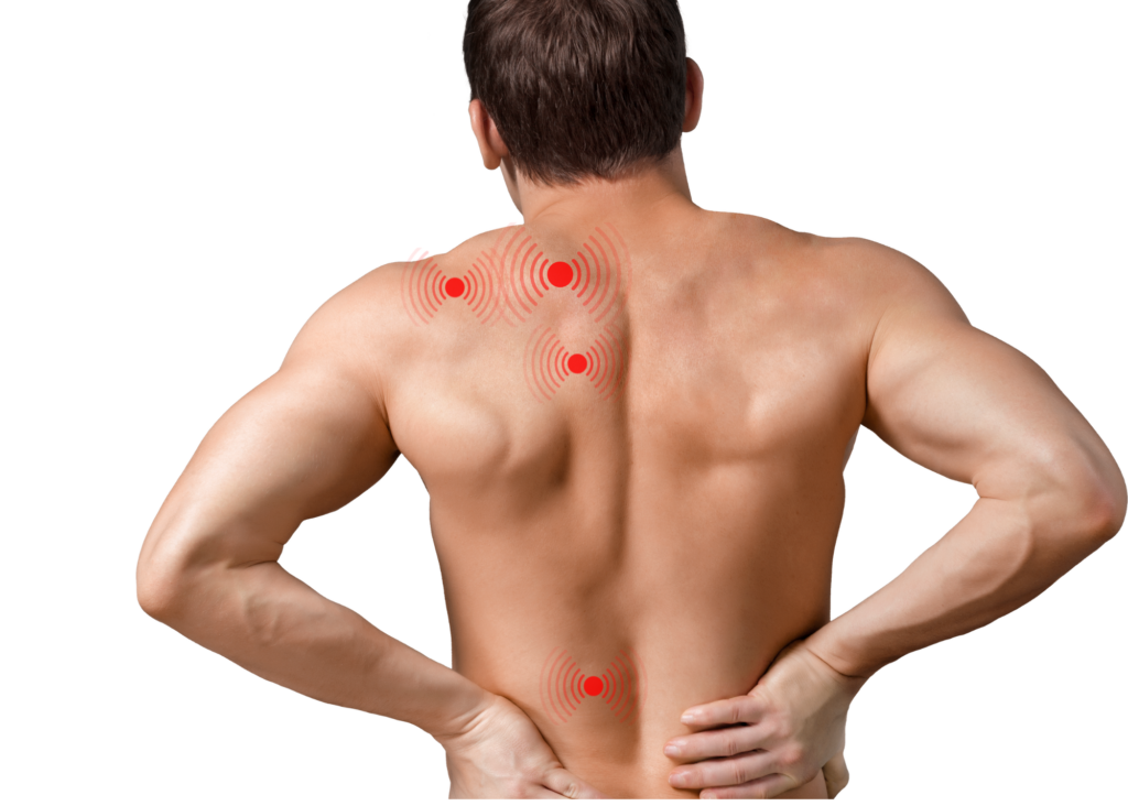 Trigger point image. Man with no shirt. Red marks hi-light his pain from trigger points